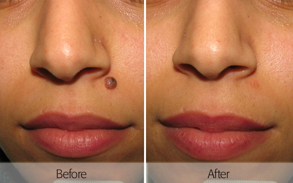 Laser Mole Removal Treatments   Cosmedics Skin Clinics